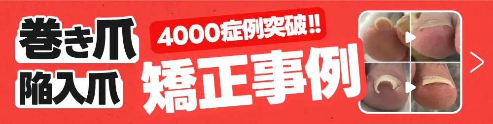 巻き爪4,000症例突破！ 矯正事例まとめはこちら