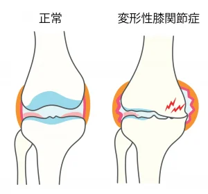 変形性膝関節を解説するイラスト素材