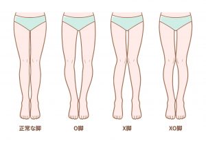 正常な足と、X脚及びO脚との比較イラスト