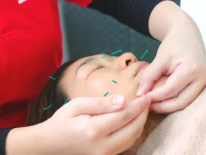 美容鍼